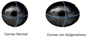Cornea normal y con astigmatismo