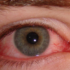 ojo con conjuntivitis