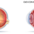 DEGENERACION MACULAR ASOCIADA A LA EDAD