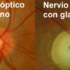glaucoma