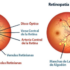 retinopatia diabetica