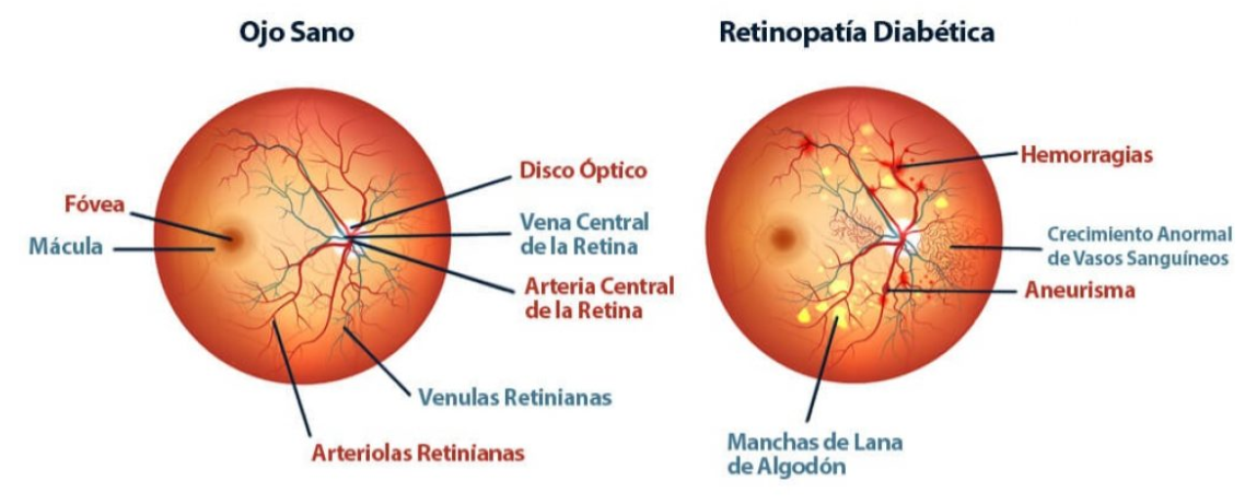 retinopatia diabetica